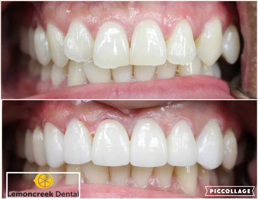 Lemoncreek Dental before and after patient photo