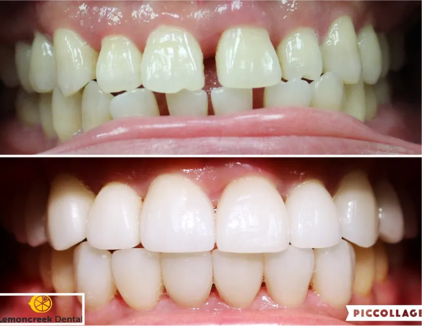 Lemoncreek Dental before and after patient photo