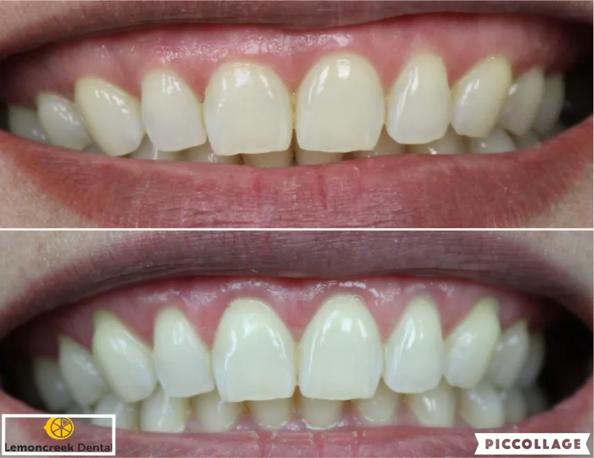 Lemoncreek Dental before and after patient photo