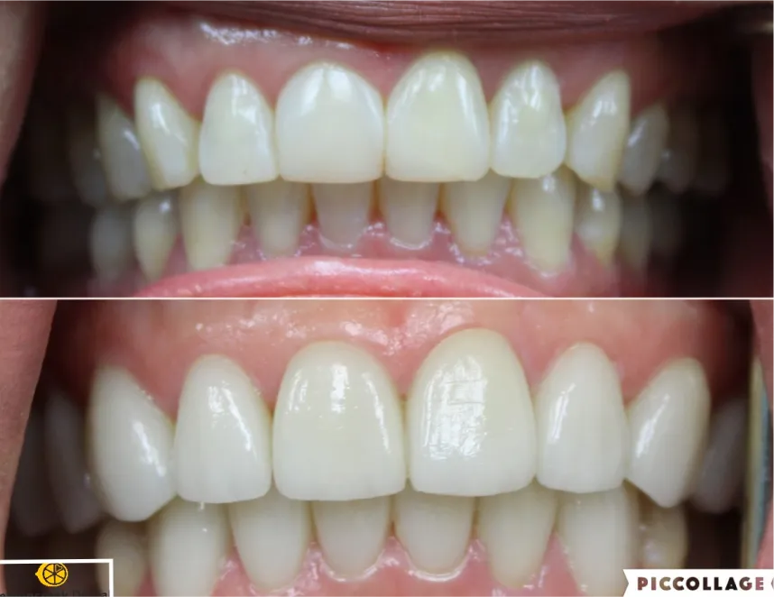 Lemoncreek Dental before and after patient photo